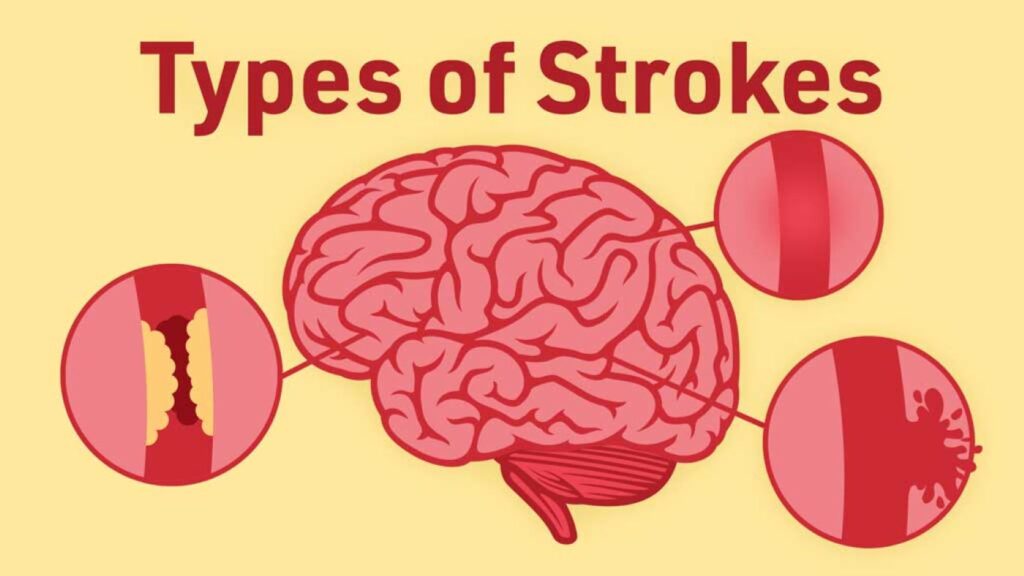 Most Common Type of Stroke Revealed