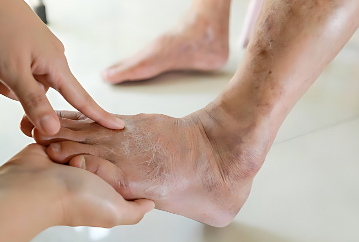 Diabetes sufferers frequently experience foot complications