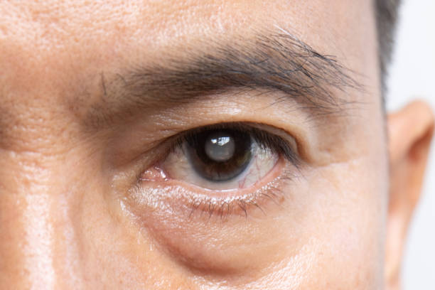 Understanding Cataracts: Causes, Symptoms, and Risk Factors