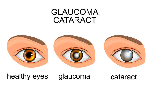 Understanding Glaucoma: Causes, Symptoms, and Risk Factors