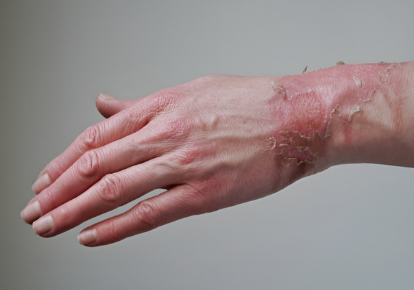 One of the symptoms of type 2 diabetes is the poor healing of cuts or sores, which is intricately linked to the interaction of decreased blood flow and weakened immune function.