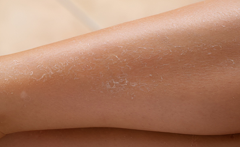 dry, flaky skin